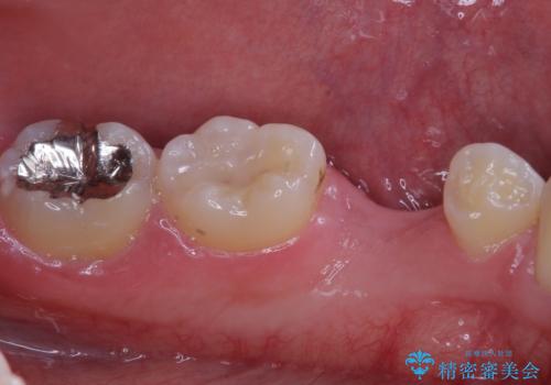 永久歯の先天欠如 インプラントによる補綴の治療前