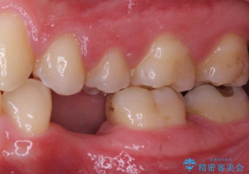 永久歯の先天欠如　インプラントによる補綴の治療前