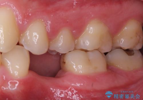 永久歯の先天欠如 インプラントによる補綴の治療前