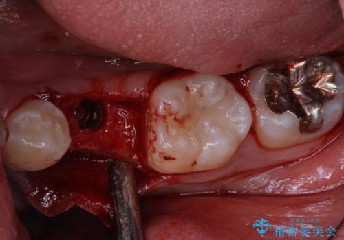 永久歯の先天欠如　インプラントによる補綴の治療前