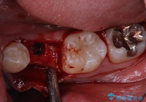 永久歯の先天欠如 インプラントによる補綴の治療前