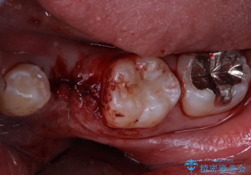 永久歯の先天欠如 インプラントによる補綴の治療中