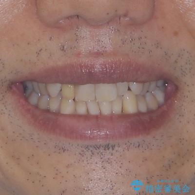 前歯のデコボコを治したい インビザラインによる矯正治療の治療前(顔貌)