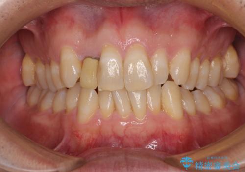 前歯のデコボコを治したい インビザラインによる矯正治療の症例 治療前