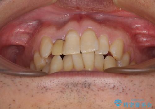 前歯のデコボコを治したい インビザラインによる矯正治療の治療前