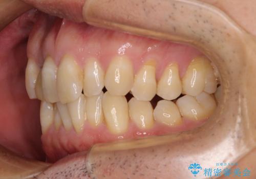 前歯のデコボコを治したい インビザラインによる矯正治療の治療前