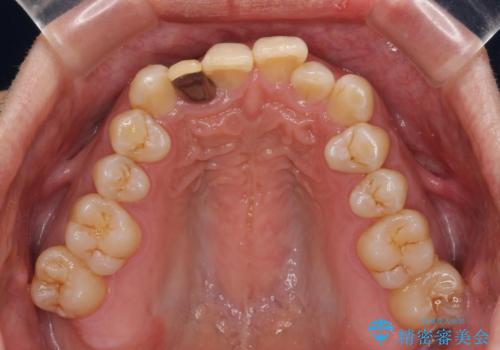 前歯のデコボコを治したい インビザラインによる矯正治療の治療前