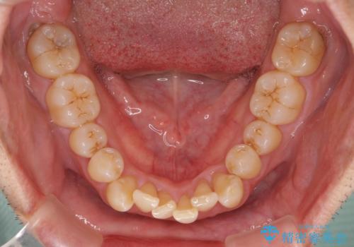 前歯のデコボコを治したい インビザラインによる矯正治療の治療前