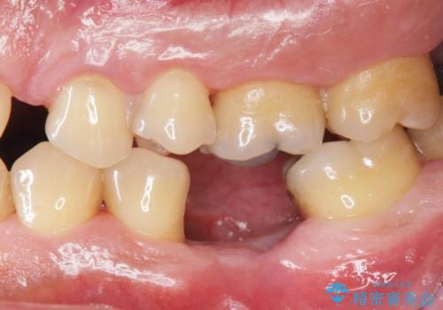 奥歯の欠損 インプラント治療の治療前