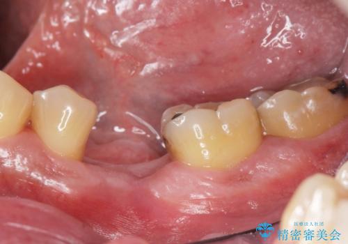 奥歯の欠損　インプラント治療の治療前