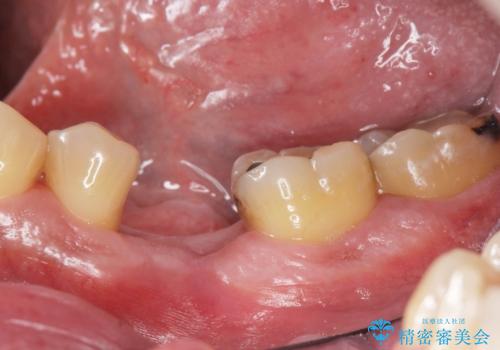 奥歯の欠損 インプラント治療の症例 治療前