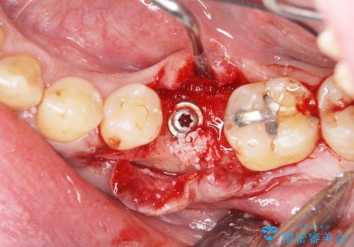 奥歯の欠損 インプラント治療の治療中