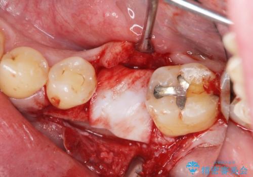 奥歯の欠損　インプラント治療の治療中