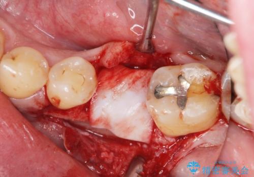 奥歯の欠損 インプラント治療の治療中