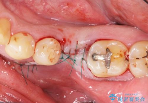 奥歯の欠損　インプラント治療の治療中