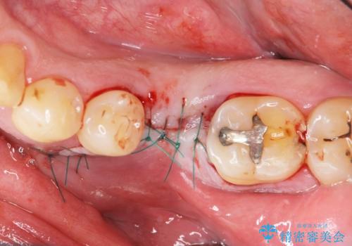 奥歯の欠損 インプラント治療の治療中