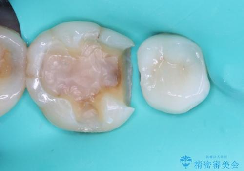食べ物が引っかかるからやり替えたい セラミックインレー修復の治療中