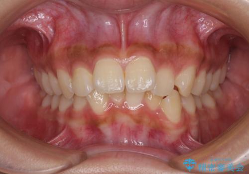 飛び出した前歯と八重歯を改善 ワイヤー装置での抜歯矯正の症例 治療前