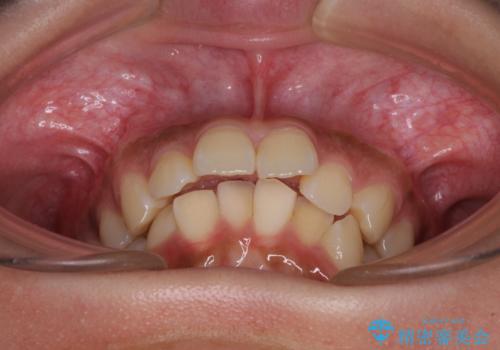 飛び出した前歯と八重歯を改善 ワイヤー装置での抜歯矯正の治療前