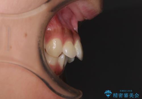 飛び出した前歯と八重歯を改善 ワイヤー装置での抜歯矯正の治療前