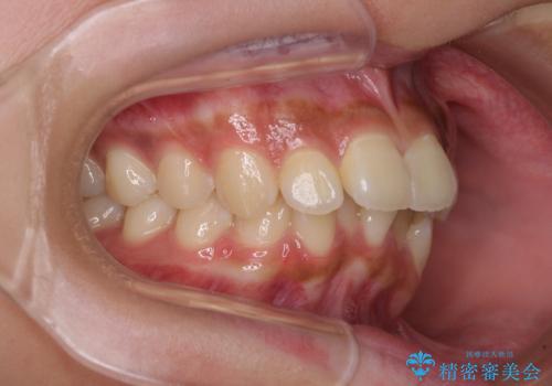 飛び出した前歯と八重歯を改善 ワイヤー装置での抜歯矯正の治療前