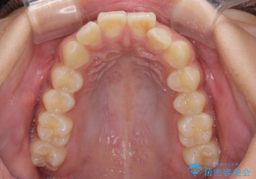 飛び出した前歯と八重歯を改善　ワイヤー装置での抜歯矯正の治療前