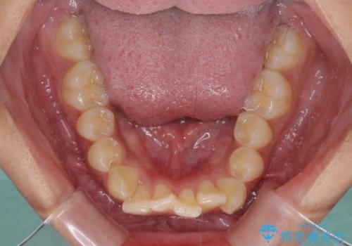 飛び出した前歯と八重歯を改善 ワイヤー装置での抜歯矯正の治療前