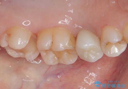 虫歯になった気がするので治療したい ゴールドインレー修復の治療中