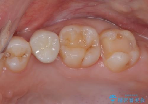 虫歯になった気がするので治療したい　ゴールドインレー修復の治療中
