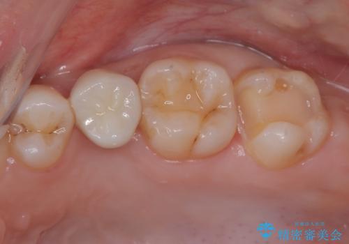 虫歯になった気がするので治療したい ゴールドインレー修復の治療中