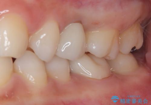 虫歯になった気がするので治療したい ゴールドインレー修復の治療中