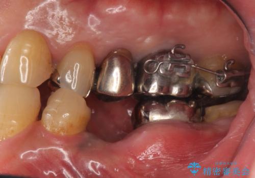 歯が割れているといわれた 奥歯にインプラントをしていきたい 全体的な治療の治療中