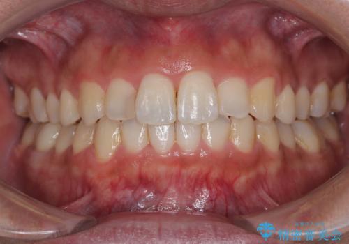 前歯のデコボコと突出感をマウスピース矯正できれいにの症例 治療後