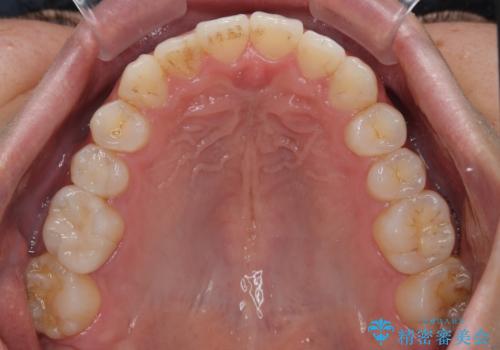 前歯のデコボコと突出感をマウスピース矯正できれいにの治療後