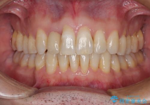 前歯のデコボコを治したい インビザラインによる矯正治療の症例 治療後