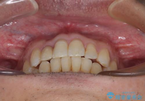 前歯のデコボコを治したい インビザラインによる矯正治療の治療後