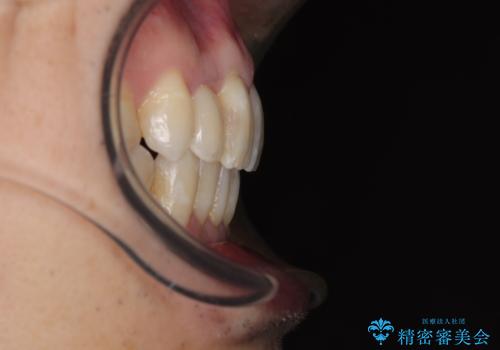 前歯のデコボコを治したい インビザラインによる矯正治療の治療後