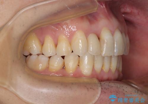 前歯のデコボコを治したい インビザラインによる矯正治療の治療後