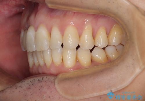 前歯のデコボコを治したい インビザラインによる矯正治療の治療後