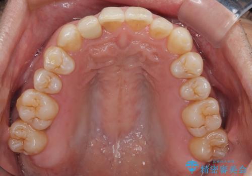前歯のデコボコを治したい インビザラインによる矯正治療の治療後