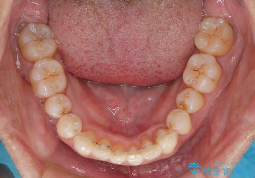 前歯のデコボコを治したい インビザラインによる矯正治療の治療後