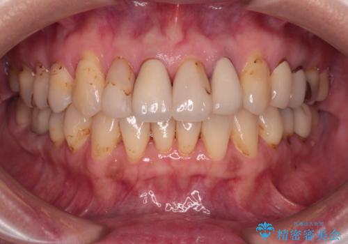 前歯をきれいにやり替えたいの症例 治療前