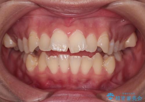 【インビザライン】シザーズバイト、抜歯矯正の治療前