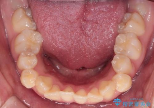 【インビザライン】シザーズバイト、抜歯矯正の治療前
