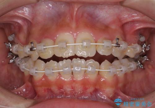 開咬と前突を改善 ワイヤー装置での抜歯矯正の治療中