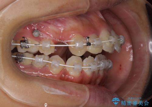 開咬と前突を改善 ワイヤー装置での抜歯矯正の治療中