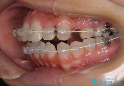 開咬と前突を改善　ワイヤー装置での抜歯矯正の治療中