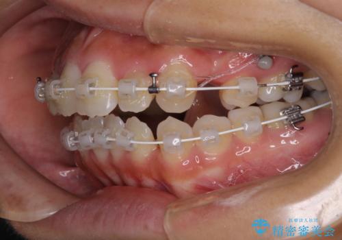 開咬と前突を改善 ワイヤー装置での抜歯矯正の治療中