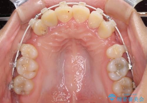 開咬と前突を改善 ワイヤー装置での抜歯矯正の治療中