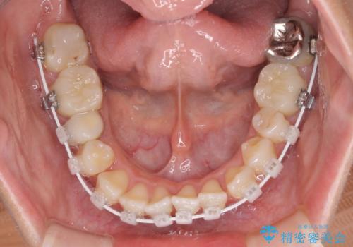 開咬と前突を改善 ワイヤー装置での抜歯矯正の治療中